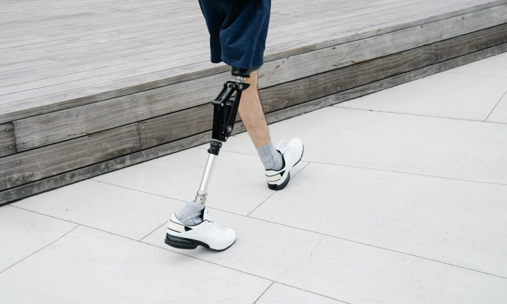 How to Walk on Your New Prosthetic Leg - Alcam Medical Orthotics